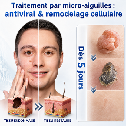 🧑‍⚕️𝐵𝑜𝑢𝑡𝑖𝑞𝑢𝑒 𝑂𝑓𝑓𝑖𝑐𝑖𝑒𝑙𝑙𝑒 | Healrize® 🌿 𝑴𝒊𝒄𝒓𝒐𝒏𝒆𝒆𝒅𝒍𝒆𝒔 – 𝑺𝒐𝒊𝒏 𝑪𝒊𝒃𝒍𝒆́ 𝒑𝒐𝒖𝒓 𝒖𝒏𝒆 𝑷𝒆𝒂𝒖 𝑷𝒍𝒖𝒔 𝑳𝒊𝒔𝒔𝒆 𝒆𝒕 𝑷𝒂𝒓𝒇𝒂𝒊𝒕𝒆 (𝑃𝑜𝑢𝑟 𝑙𝑒𝑠 𝑎𝑐𝑟𝑜𝑐ℎ𝑜𝑟𝑑𝑜𝑛𝑠, 𝑙𝑒𝑠 𝑝𝑒𝑡𝑖𝑡𝑒𝑠 𝑒𝑥𝑐𝑟𝑜𝑖𝑠𝑠𝑎𝑛𝑐𝑒𝑠 𝑐𝑢𝑡𝑎𝑛é𝑒𝑠, 𝑙𝑒𝑠 𝑣𝑒𝑟𝑟𝑢𝑒𝑠, 𝑙𝑒𝑠 𝑔𝑟𝑎𝑖𝑛𝑠 𝑑𝑒 𝑏𝑒𝑎𝑢𝑡é, 𝑙𝑒𝑠 𝑡𝑎𝑐ℎ𝑒𝑠 𝑑𝑒 𝑣𝑖𝑒𝑖𝑙𝑙𝑒𝑠𝑠𝑒 𝑒𝑡 𝑙𝑒𝑠 𝑝𝑟𝑜𝑏𝑙è𝑚𝑒𝑠 𝑑𝑒 𝑝𝑖𝑔𝑚𝑒𝑛𝑡𝑎𝑡𝑖𝑜𝑛）